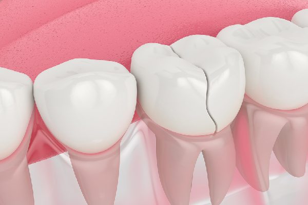 Cracked Teeth
                