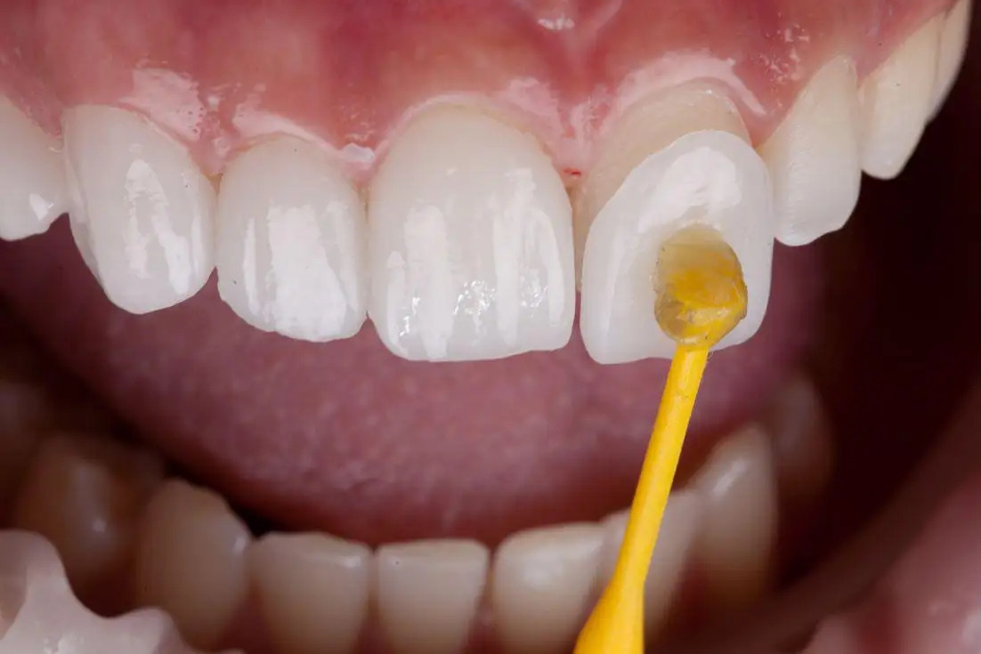 Veneer